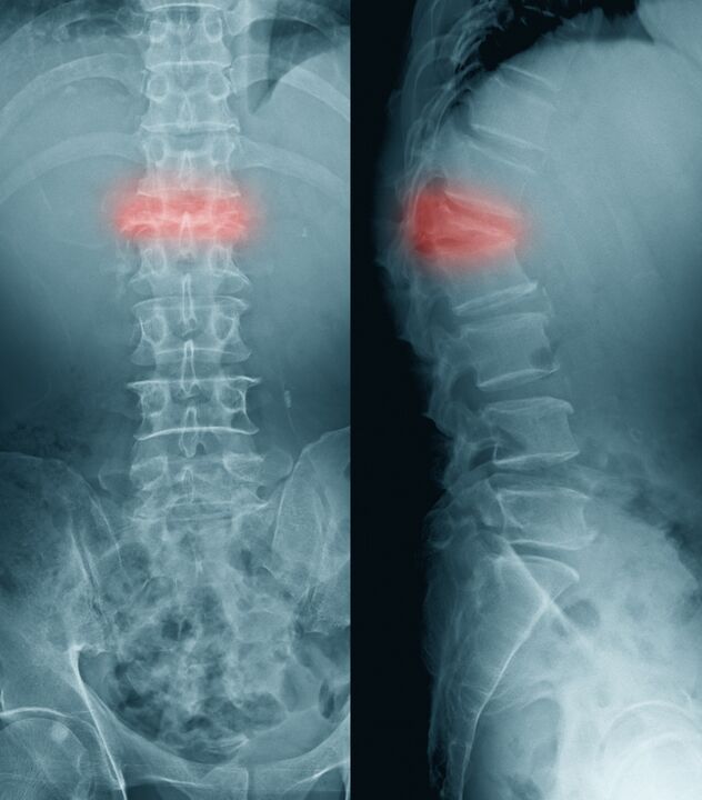 diagnostico de dolor de espalda