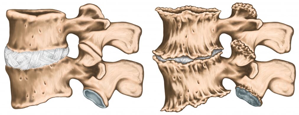 dolor de espalda debido a una lesión de la médula espinal