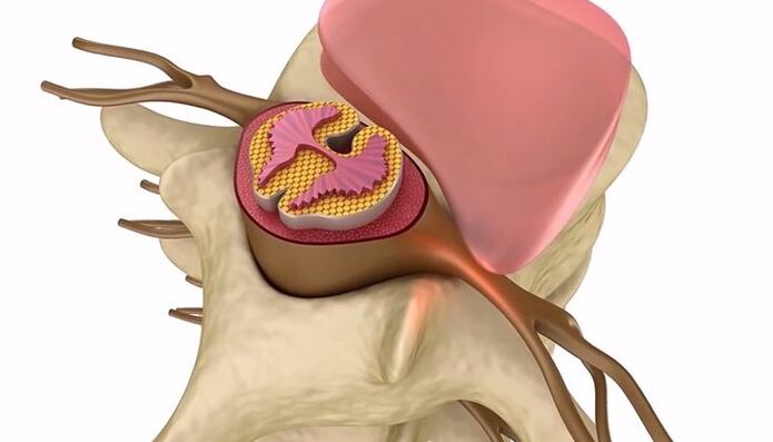 lesión de la médula espinal en la osteocondrosis torácica