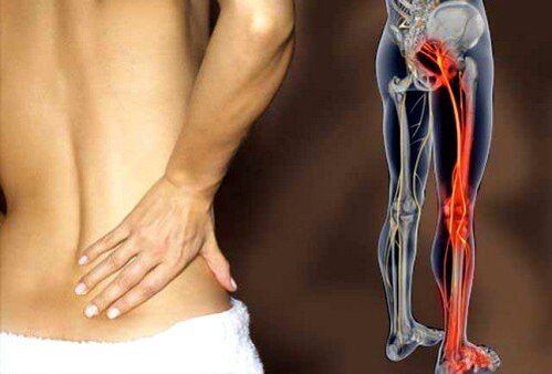 dolor de espalda baja debido a la inflamación del nervio ciático