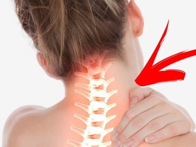 Compresión de la raíz nerviosa con osteocondrosis cervical