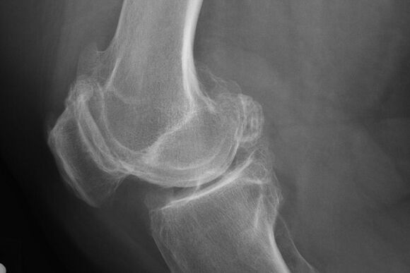 Método para diagnosticar la artrosis de la rodilla