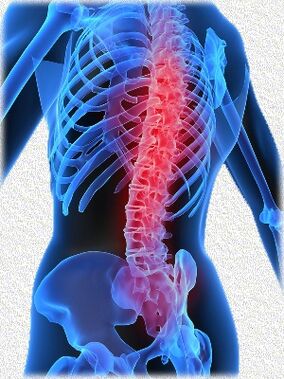 osteocondrosis y sus métodos de tratamiento