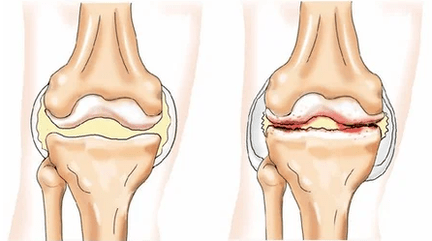 Condromatosis