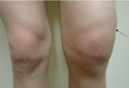 Hemartrosis de la articulación de la rodilla.